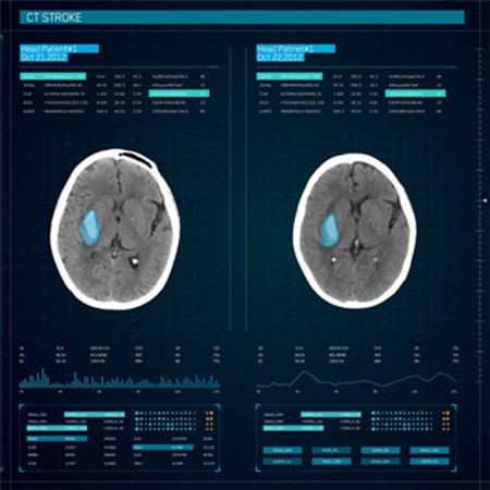 InferRead® CT 脑卒中智能解决方案;人工智能与机器人产业平台解决方案