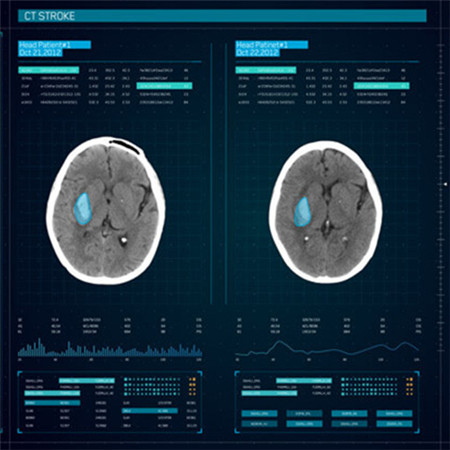 InferRead® CT 脑卒中智能解决方案;章鱼通解决方案