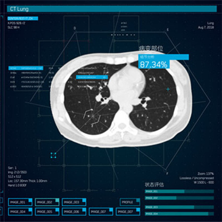 InferRead® CT 肺部疾病智能解决方案;章鱼通解决方案