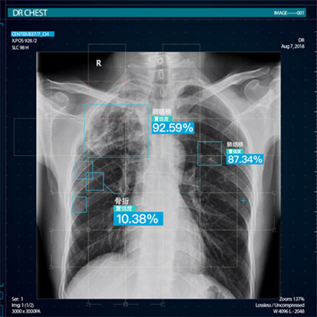 InferRead® DR 胸部疾病智能解决方案;章鱼通解决方案