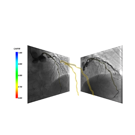 冠状动脉造影FFR分析系统;章鱼通智能产品