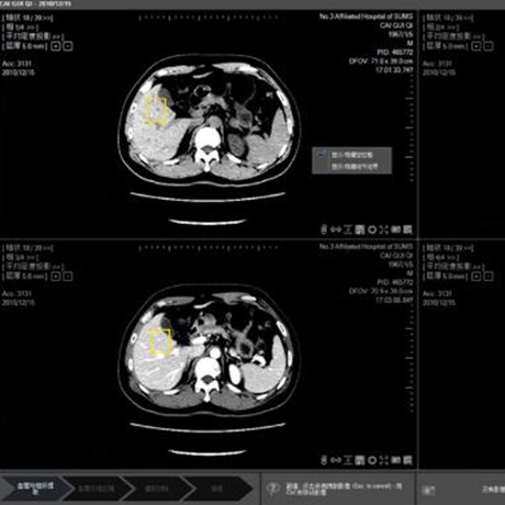 CT 肝脏 CT 智能辅助诊断系统 ;章鱼通智能产品