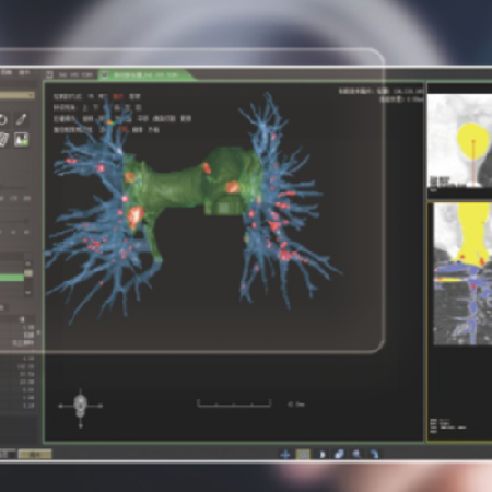 肺动脉栓塞评估系统;章鱼通智能产品