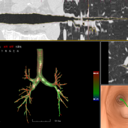 支气管虚拟内窥镜系统;章鱼通智能产品