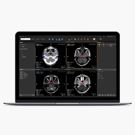 靶区勾画放疗云平台;章鱼通智能产品